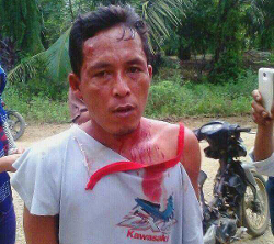 Medium_2016-11-22_zulkifli_-_a_farmer_who_was_injured_in_the_protest